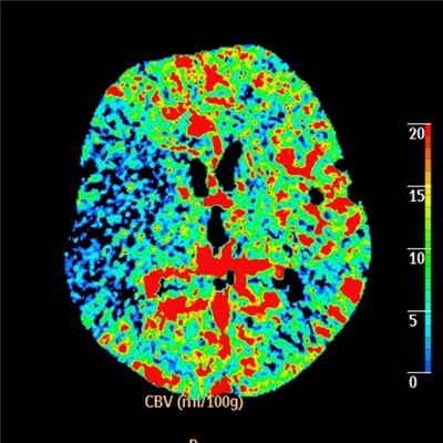 Snížený krevní průtok v pravé mozkové hemisféře při cévní mozkové příhodě. Foto: Krajská zdravotní  a.s. 