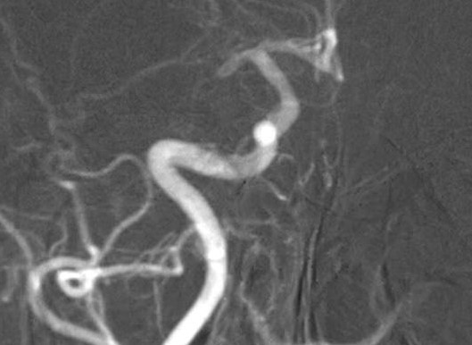 Zobrazení uzávěry cévy v mozku na rentgenovém snímku. Foto: Krajská zdravotní  a.s.