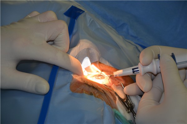Zavedení gelového implantátu XEN ke snížení nitroočního tlaku. Foto: KZ  a. s./Petr Sochůrek