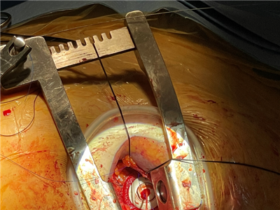 Pohled na operační přístup přes srdeční hrot s již implantovanou a fixovanou chlopní speciální „zátkou“.