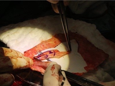 Kardiochirurgové nejprve pacientovi voperovali aortokoronární bypass a dále vytvořili náhradu chlopně z osrdečníku, z tkáně vazivového obalu srdce pacienta. Tu pak všitím cípů umístili na aortální pozici. Foto: Krajská zdravotní, a.s.